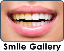 teeth whitening 48070