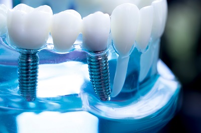 oak park dental implants